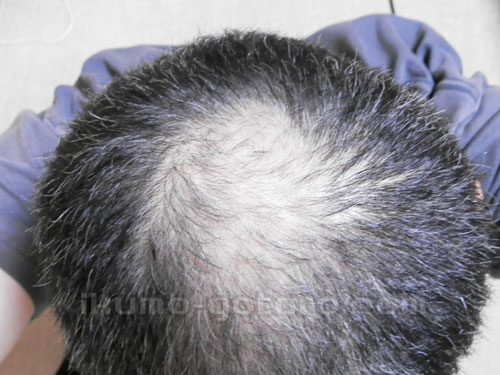 ヘアマックス使用開始前