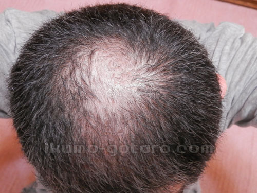 ヘアマックス使用3か月目