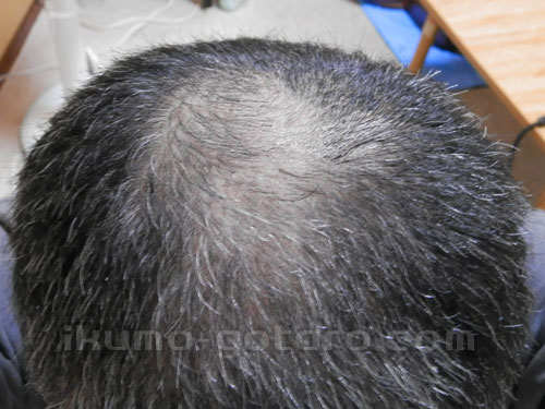ヘアマックス使用４か月目