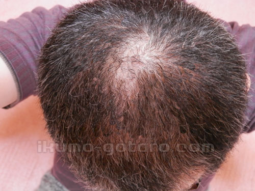 ヘアマックス使用６か月目